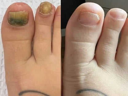 LBMLBM™ Antifungal Pen-UNDECYLENIC ACID25%-Cures Most Athlete's Foot, Jock ltch, andRingworm