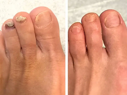 LBMLBM™ Antifungal Pen-UNDECYLENIC ACID25%-Cures Most Athlete's Foot, Jock ltch, andRingworm