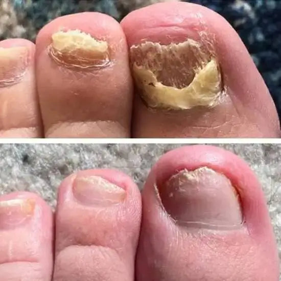 LBMLBM™ Antifungal Pen-UNDECYLENIC ACID25%-Cures Most Athlete's Foot, Jock ltch, andRingworm