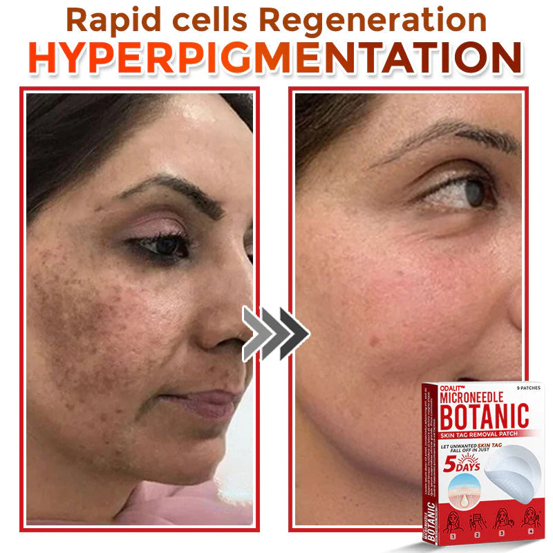 🌈 ODALIT™MicroNeedle Botanic Skin Tag Removal Patch