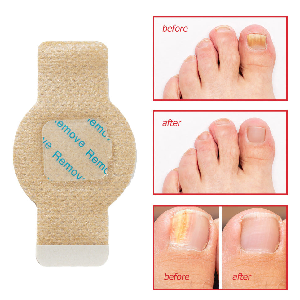 ✅Toenail Fungus Treatment Extra Strength - 21 Nighttime Hydrogel Patches for Overnight Toenail Repair🏥