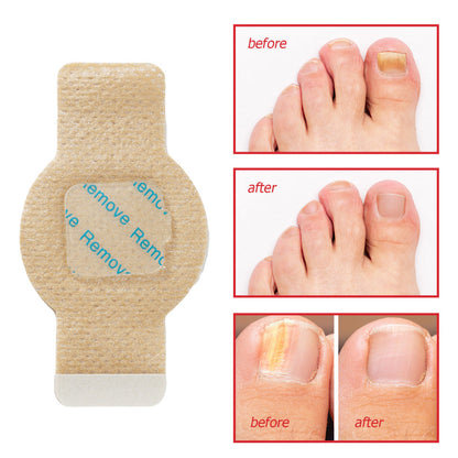 ✅Toenail Fungus Treatment Extra Strength - 21 Nighttime Hydrogel Patches for Overnight Toenail Repair🏥