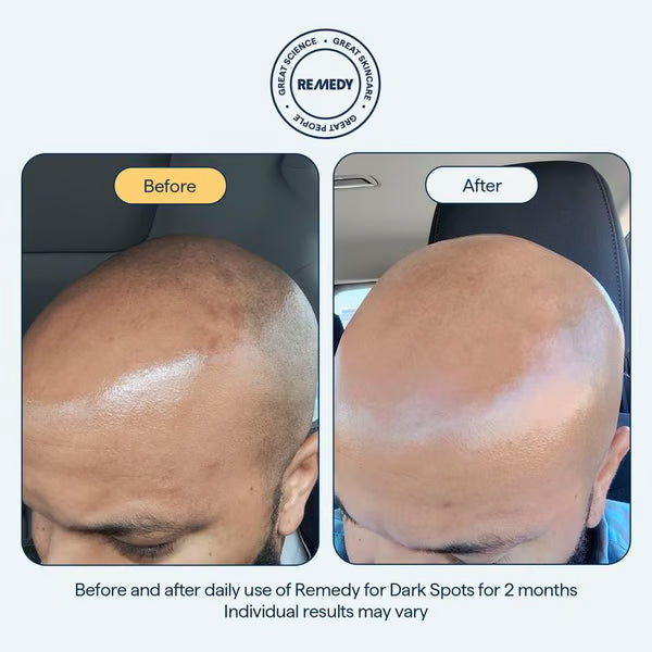 🧴Last Day Promotion 49% OFF- ✨ REMEDY for Dark Spots - All-in-One Nightly Serum for Fading Dark Spots & Evening Skin Tone with Retinol, Kojic Acid & Tranexamic Acid