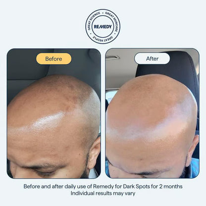 🧴Last Day Promotion 49% OFF- ✨ REMEDY for Dark Spots - All-in-One Nightly Serum for Fading Dark Spots & Evening Skin Tone with Retinol, Kojic Acid & Tranexamic Acid