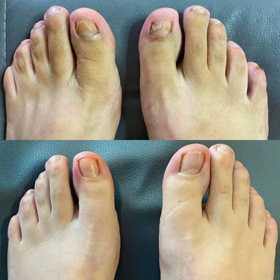 LBMLBM™ Antifungal Pen-UNDECYLENIC ACID25%-Cures Most Athlete's Foot, Jock ltch, andRingworm